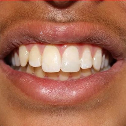 Zirconia Crown in Dubai