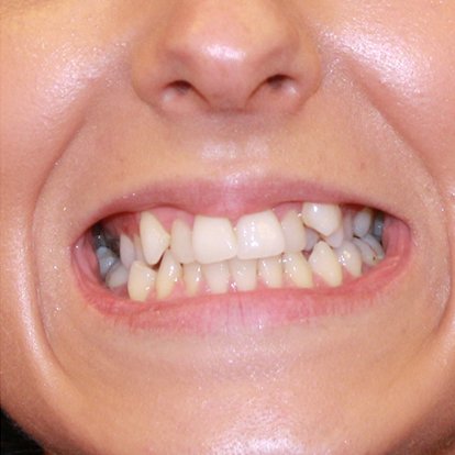 Best Protruding Teeth Treatment in Dubai