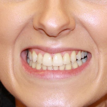 Best Protruding Teeth Treatment in Dubai