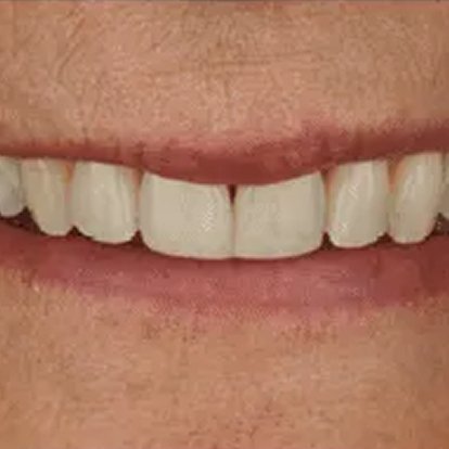 Invisalign Aligners Dubai