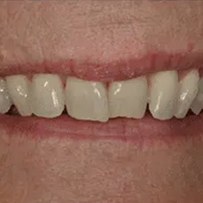 Invisalign Aligners Dubai