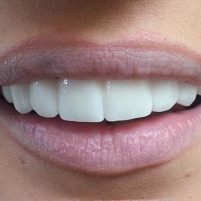 Invisalign Aligners Dubai