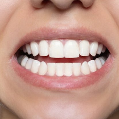 Best Protruding Teeth Treatment in Dubai
