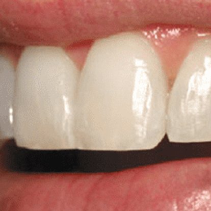Best Protruding Teeth Treatment