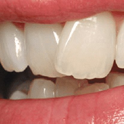Protruding Teeth Treatment