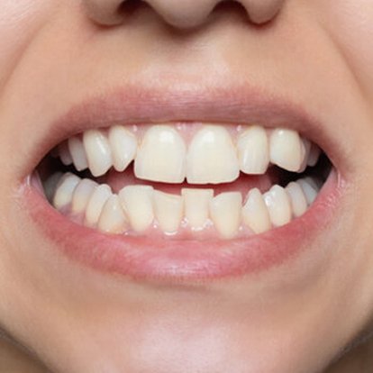 Protruding Teeth Treatment